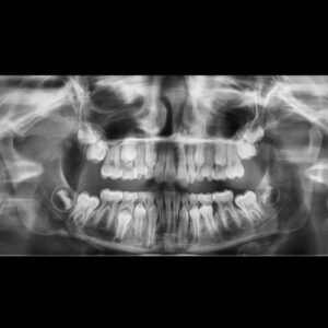 Radiographie panoramique