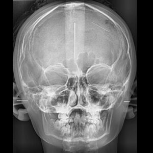 Téléradiograpie de face