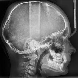 Téléradiographie de profil
